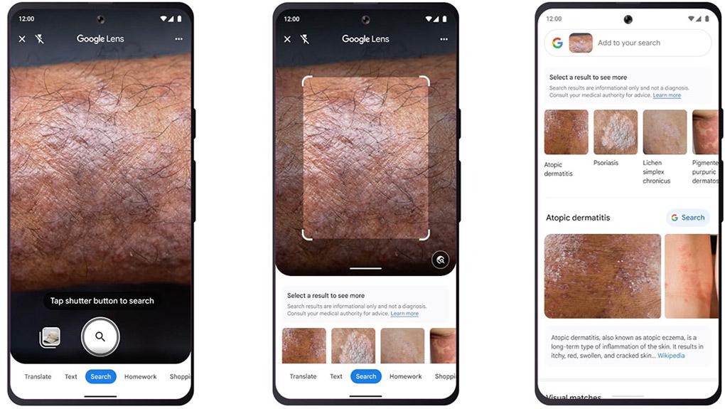 Avec Google Lens, votre smartphone identifie les problèmes de peau