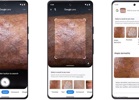 Avec Google Lens, votre smartphone identifie les problèmes de peau